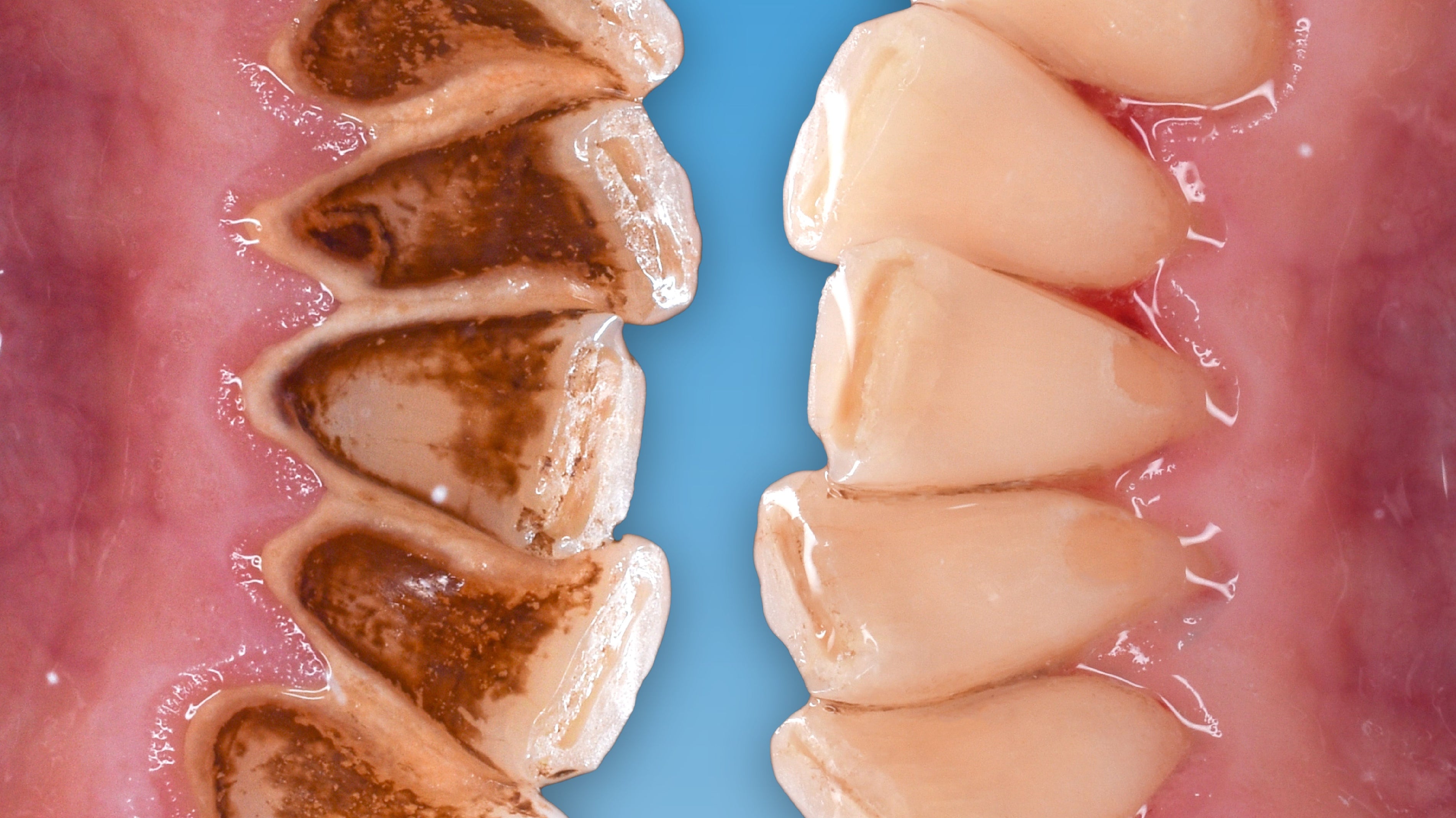 Zahnarzt erklärt: Warum theranovis® die Zahnsteinbildung reduziert