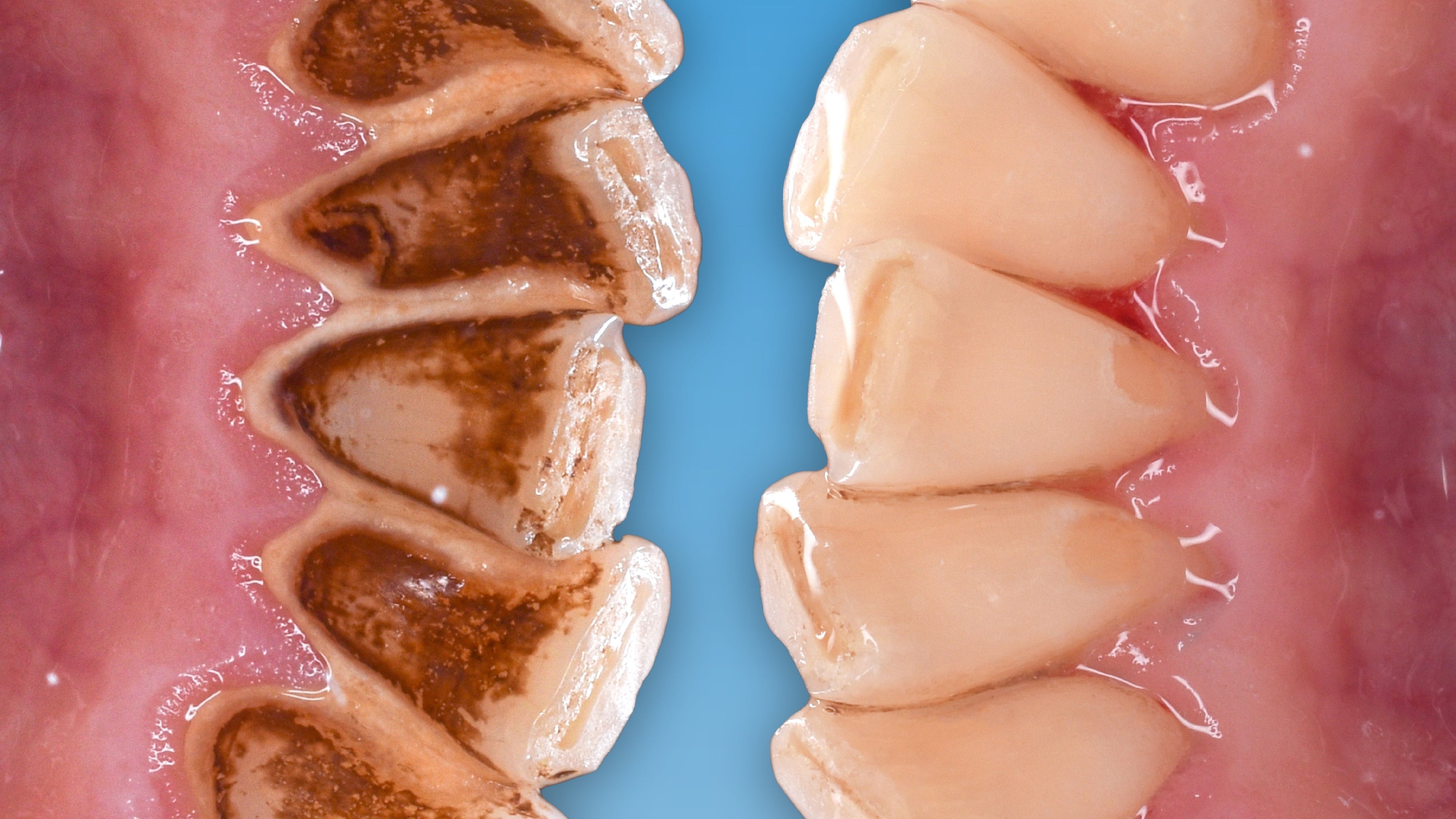 Zahnarzt erklärt: Warum theranovis die Zahnsteinbildung reduziert