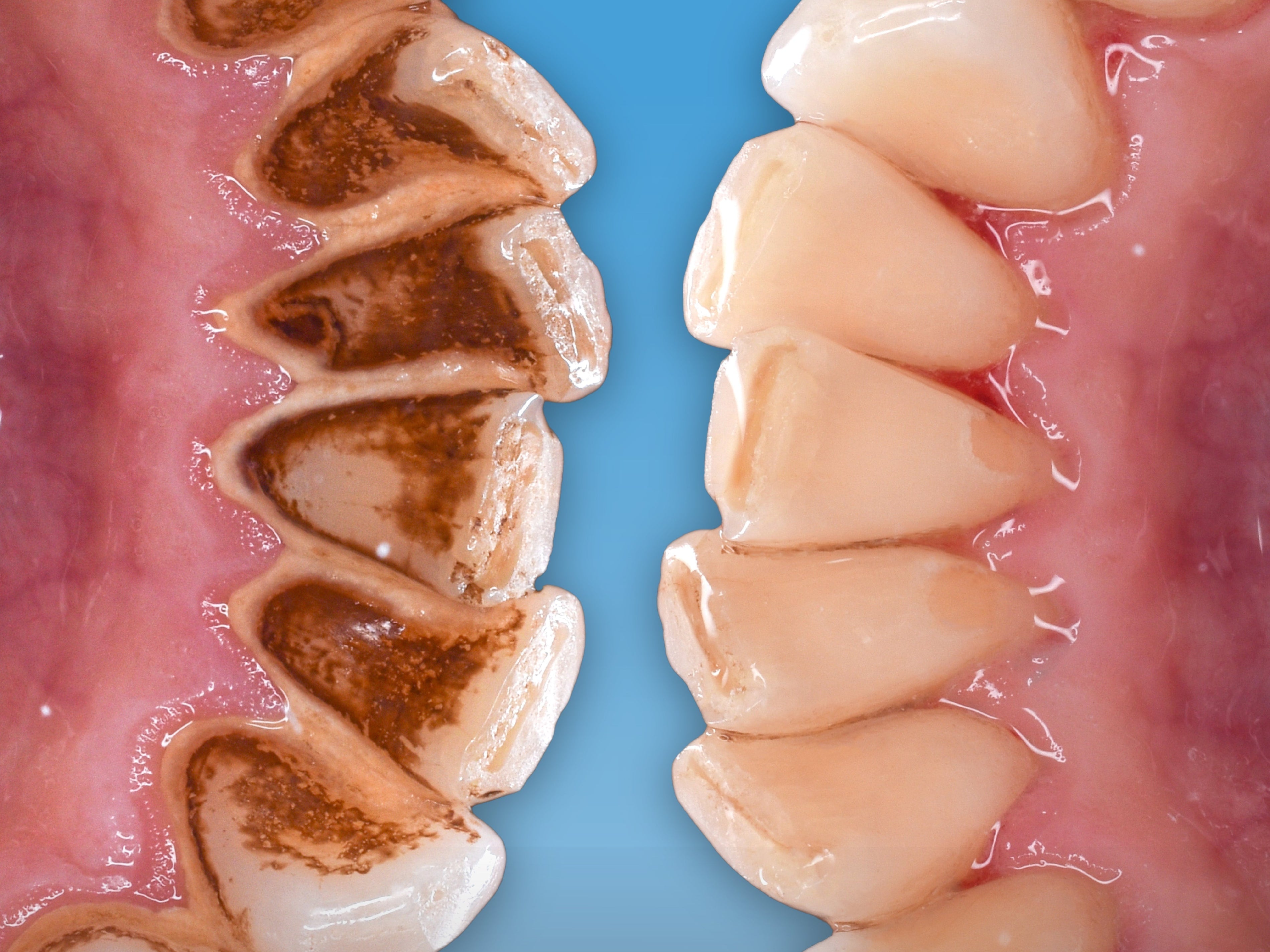 Zahnarzt erklärt: Warum theranovis die Zahnsteinbildung reduziert