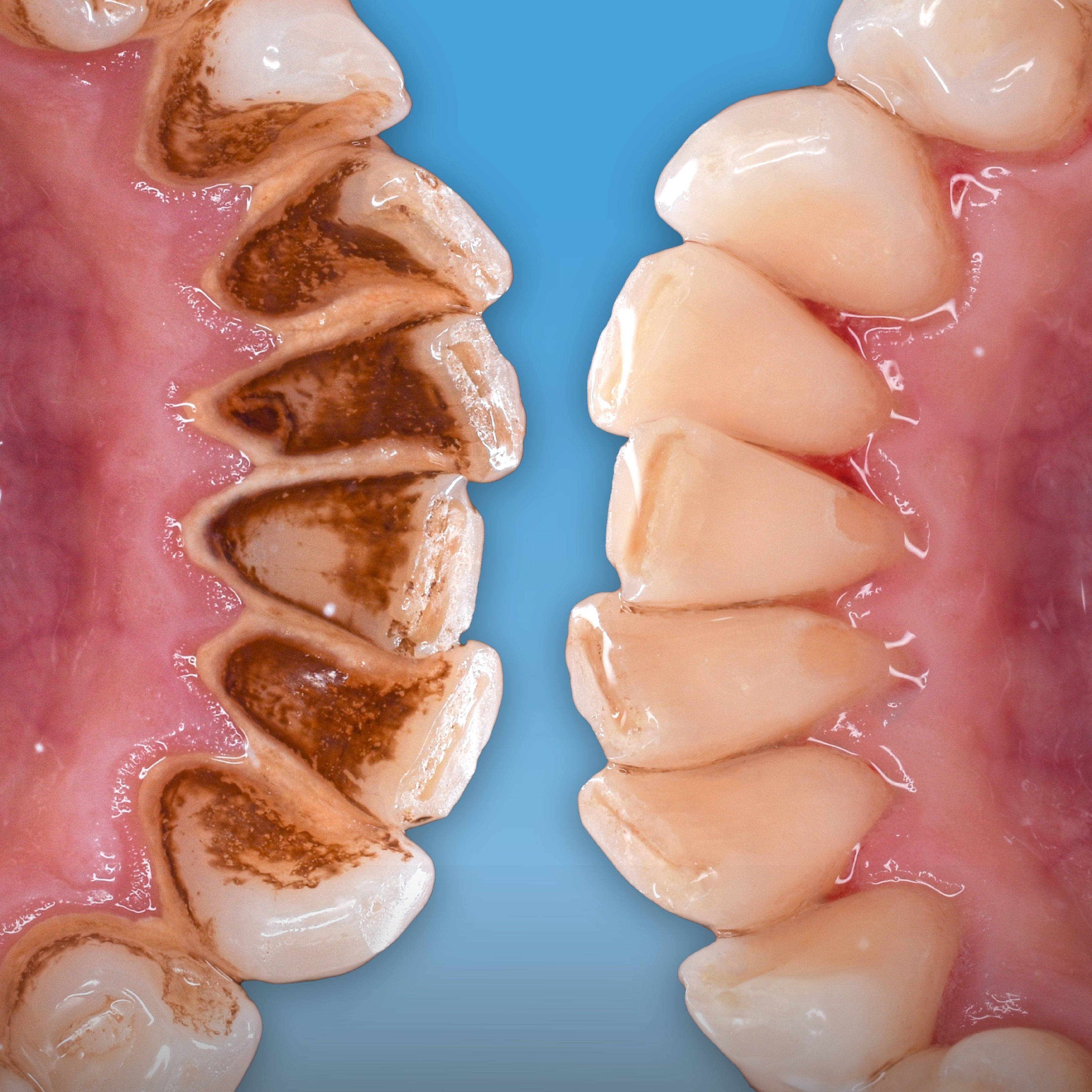 Zahnarzt erklärt: Warum theranovis die Zahnsteinbildung reduziert